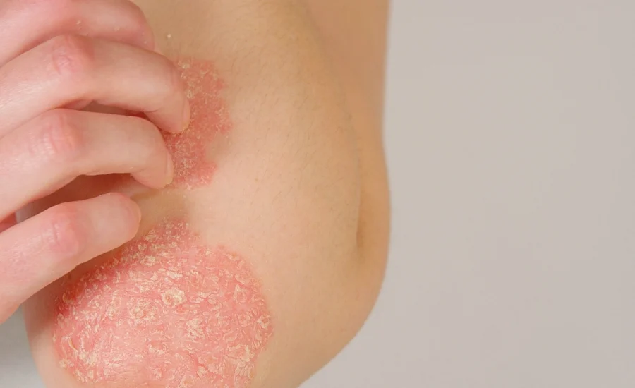 05.Dermatolog Dr. Muge Karaali Psoriasis