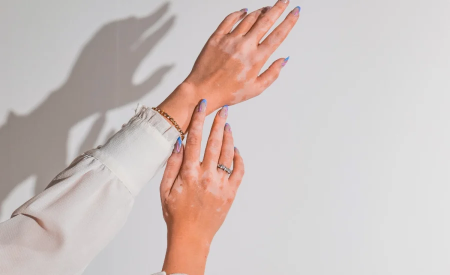 07.Dermatolog Dr. Muge Karaali Vitiligo