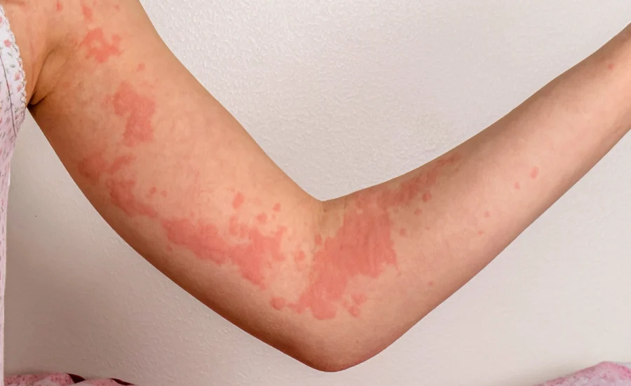 08.Dermatolog Dr. Muge Karaali Urtikler