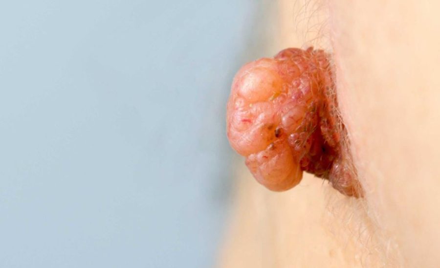 dr muge gore karaali Sigil HPV enfeksiyonu